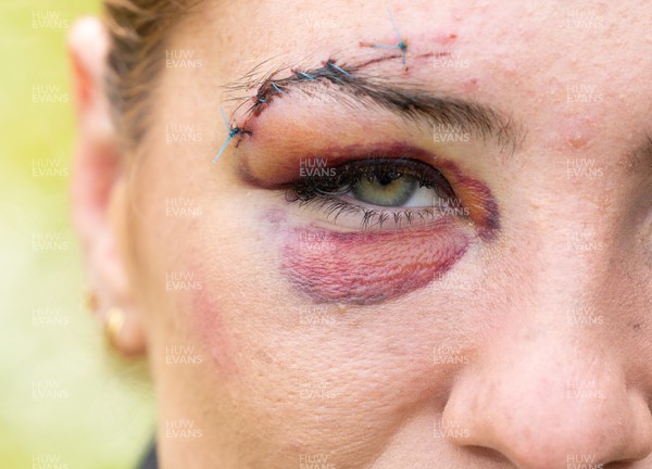 241023 - Wales’ Georgia Evans shows the aftermath of the injury she picked up after a clash with Olivia Apps of Canada in the first match of WXV1 in Wellington, New Zealand