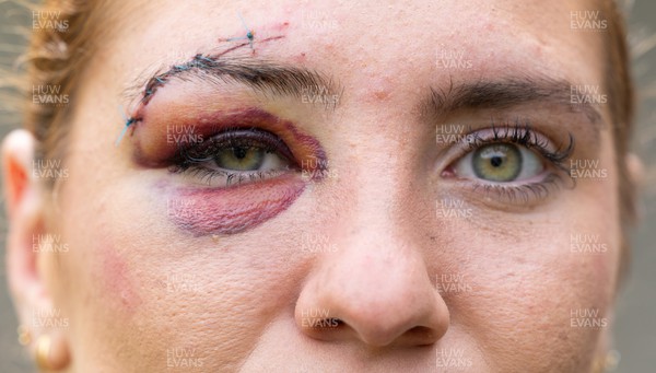 241023 - Wales’ Georgia Evans shows the aftermath of the injury she picked up after a clash with Olivia Apps of Canada in the first match of WXV1 in Wellington, New Zealand
