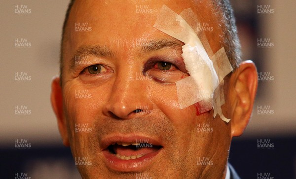 250117 - RBS 6 Nations Launch - England Coach Eddie Jones with his face bandaged up after an incident before the launch