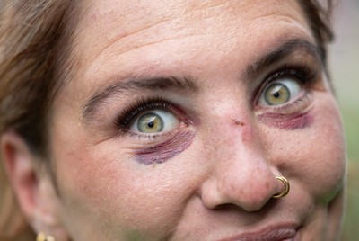 250926 Wales Women Captain’s Run - Georgia Evans, who will win her 50th cap, shows the bruising of a training pitch collision during Captains Run at Cardiff Arms Park ahead of the WXV match against the USA